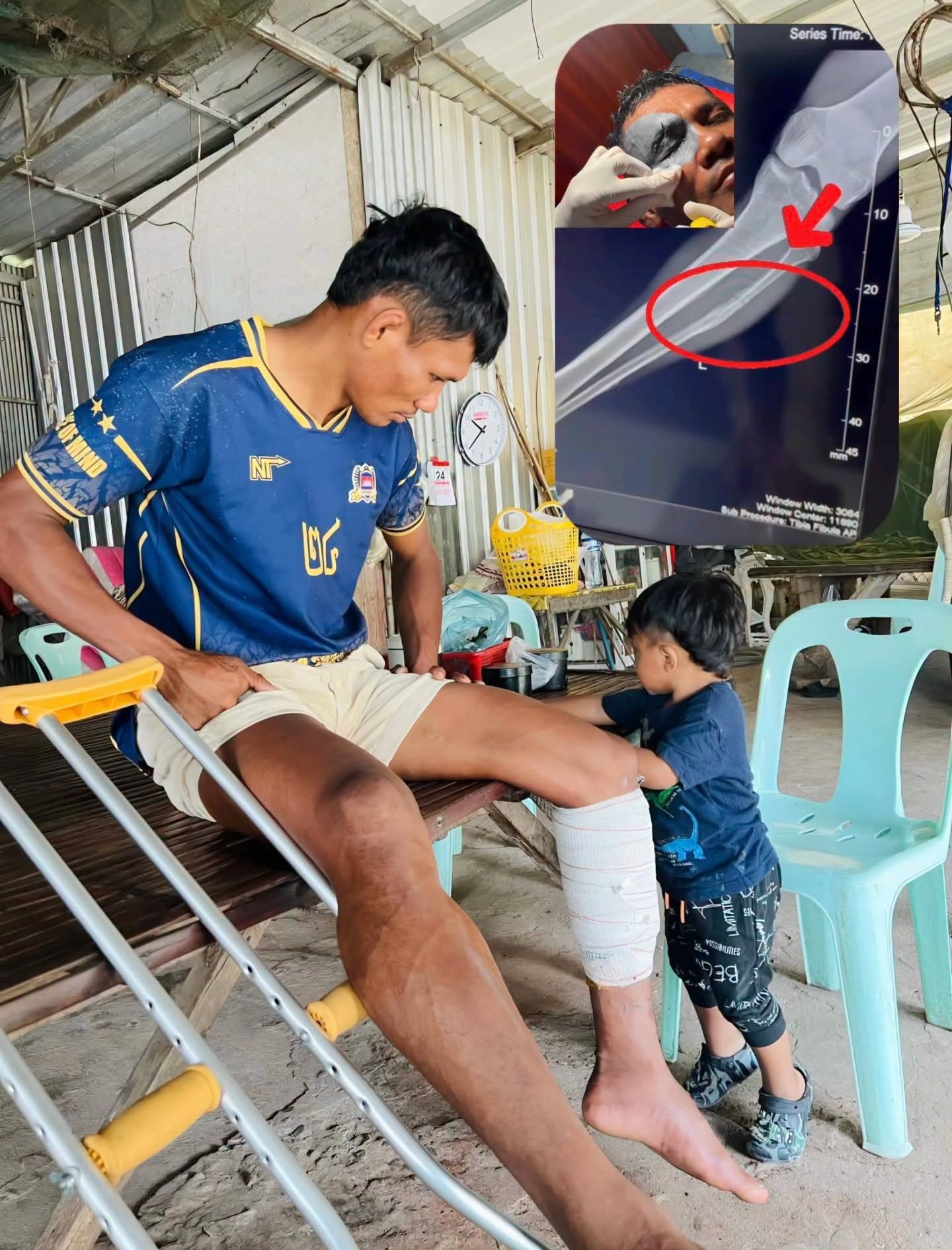 កីឡាករ ឡុង បេនលឿន របួស